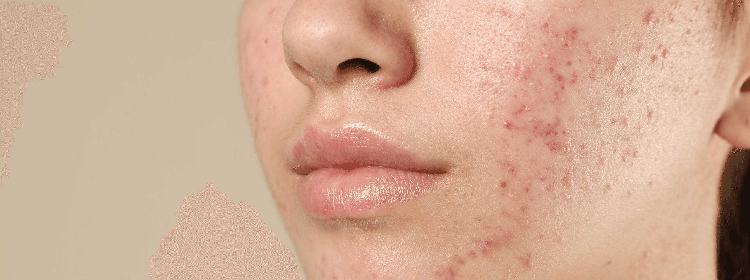 persona con acne hormonal